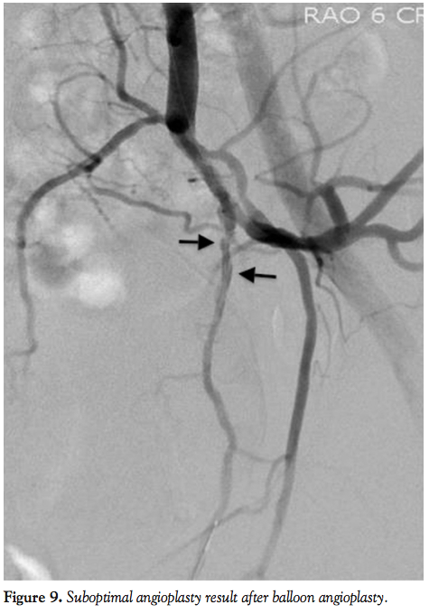 Angiography And Endovascular Revascularization Of Pudendal Artery angiography-and-endovascular-revascularization-of-pudendal-artery